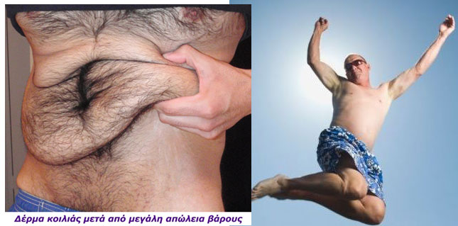 ΚΟΙΛΙΟΠΛΑΣΤΙΚΗ ΜΕΓΑΛΗ ΑΠΩΛΕΙΑ ΒΑΡΟΥΣ